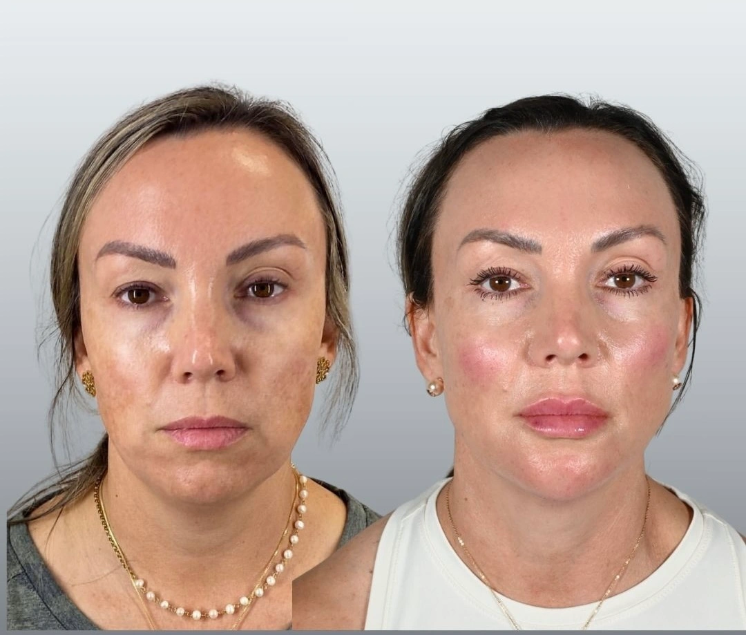 Face IQ Aesthetics before & after